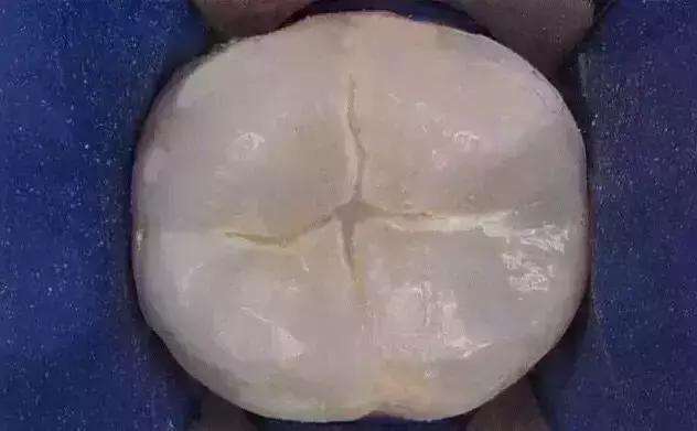 儿童窝沟封闭和龋齿填充,幼儿牙齿窝沟填充有必要吗