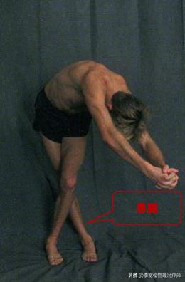 老生常谈跑步膝:髂胫束综合征(ITBS)