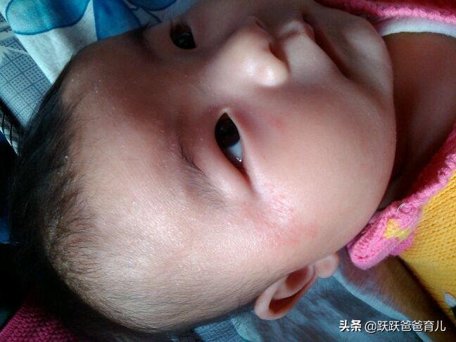 治疗湿疹的最好土办法除根,治疗湿疹图片