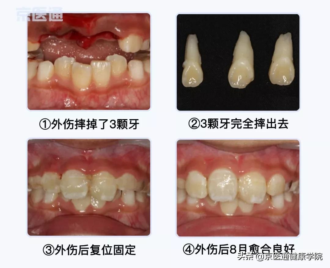 牙受伤后怎么保护,摔掉牙快速消肿方法