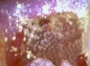 拔牙后出现干槽症怎么办,拔牙干槽症治疗