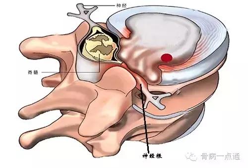 左肩膀痛如何区别肩周炎或颈椎病,肩膀疼不是肩周炎肯定是癌症吗