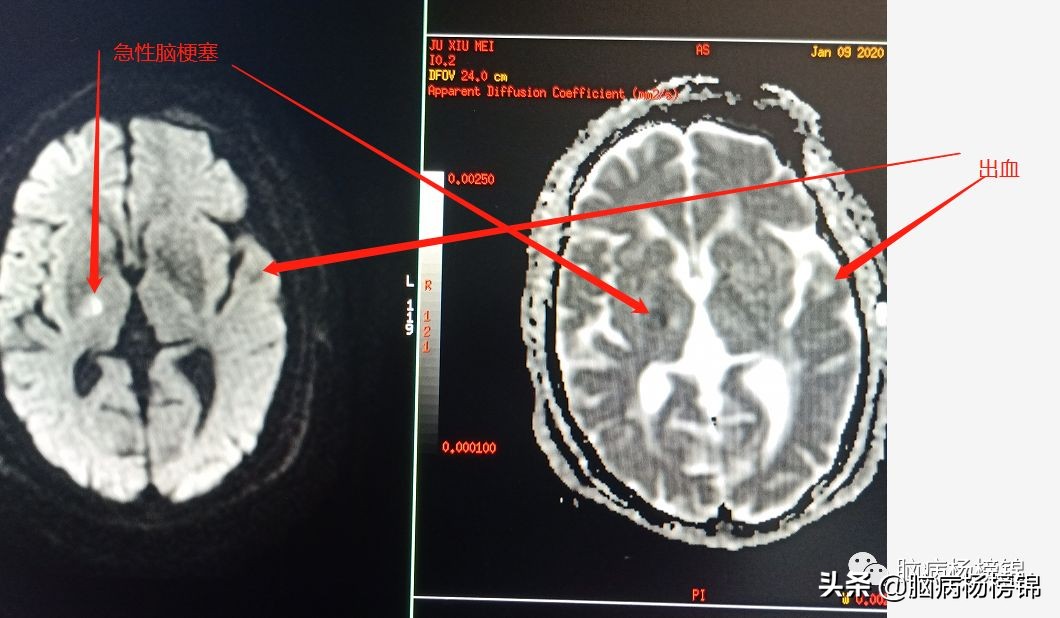 脑出血和脑梗塞同时出现已经昏迷,急性脑梗塞和急性脑出血同时出现