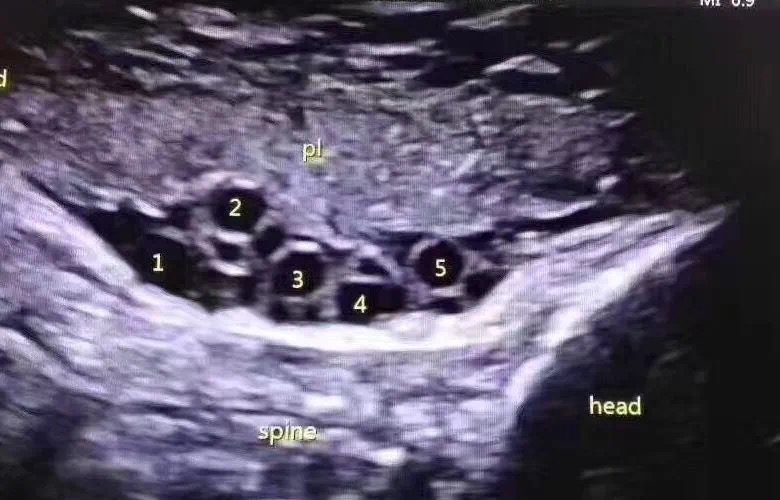 胎儿脐带绕颈有什么症状,胎儿脐带绕颈的症状有哪些