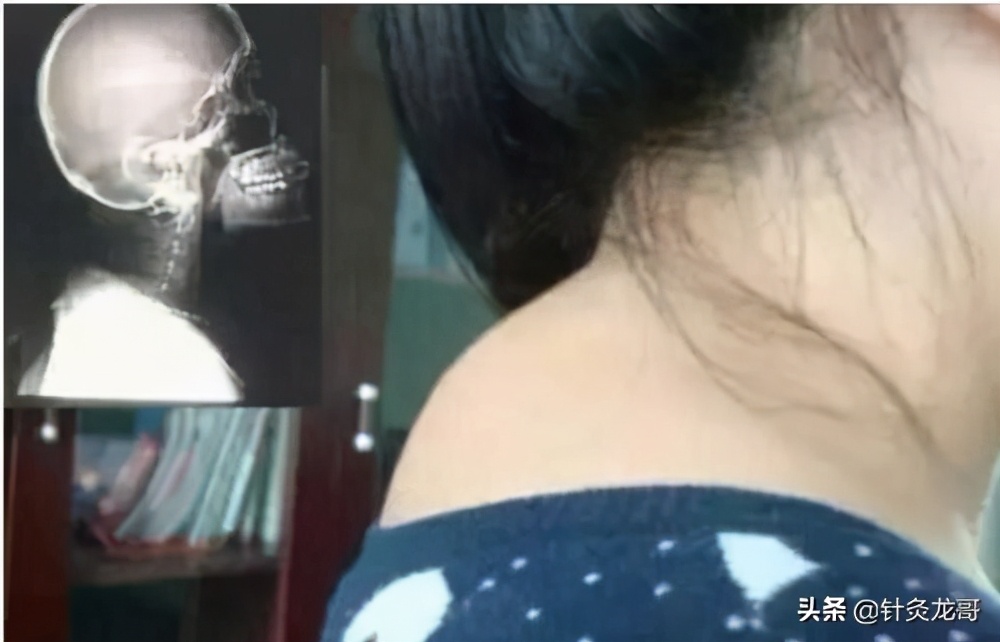 富贵包针灸和小针刀哪个效果好,富贵包可以针灸吗有什么效果