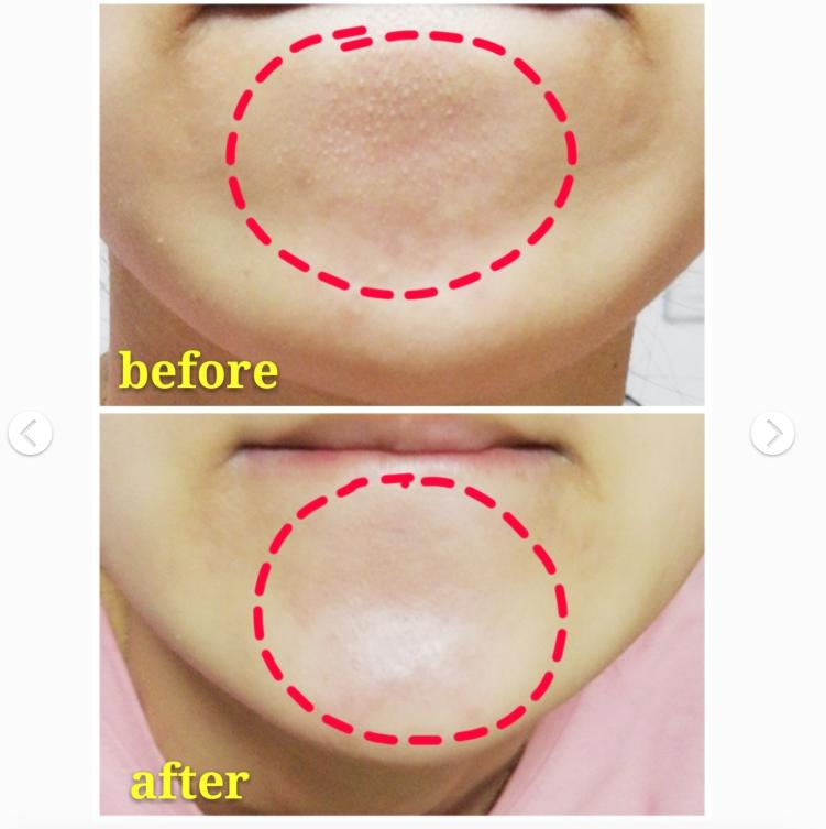 清理粉刺闭口后怎么护肤好点,如何去闭口粉刺最有效的方法