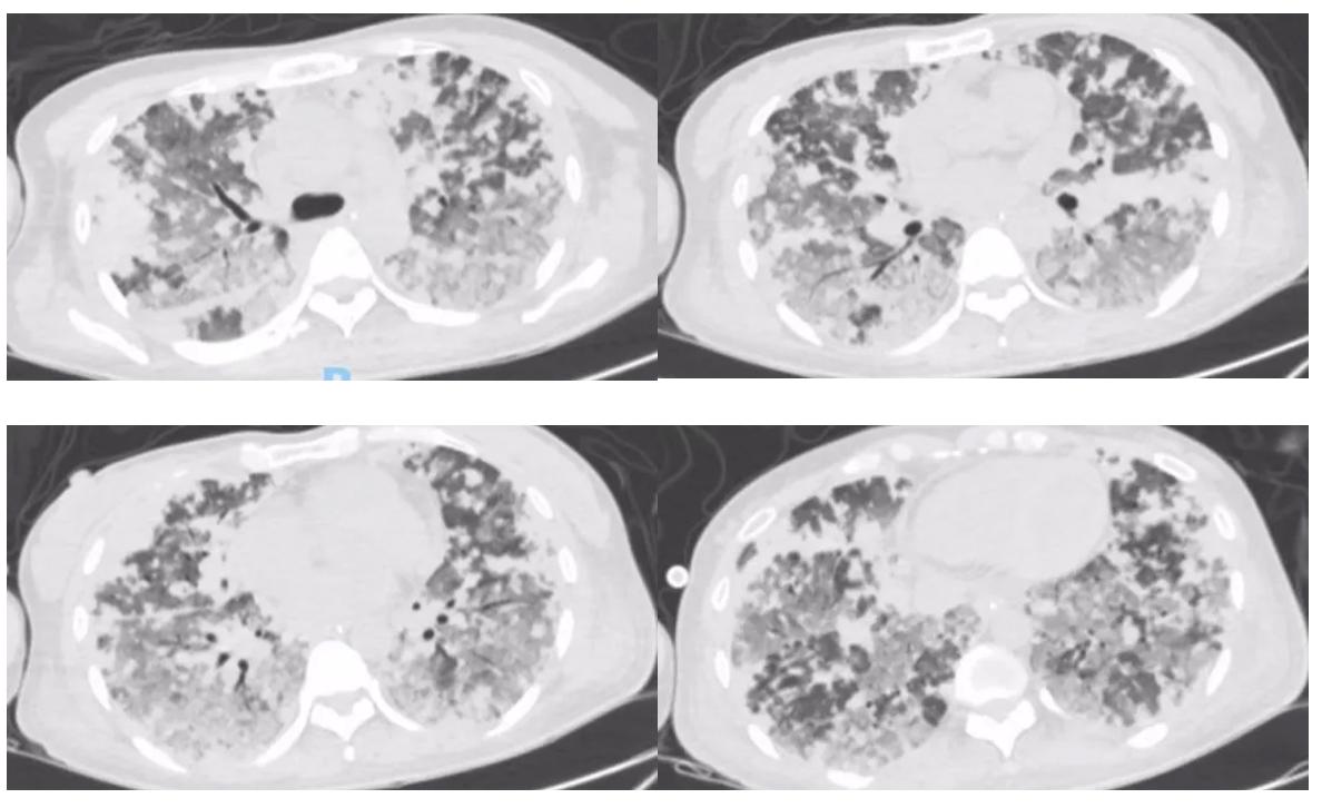 弥漫性肺泡出血是怎么回事,弥漫性肺泡出血症病因分类