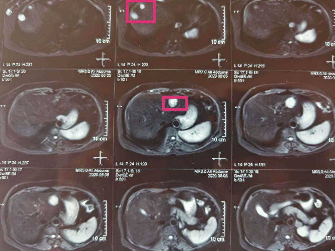 哈尔滨肿瘤医院结直肠癌专家,哈医大二院切胃手术