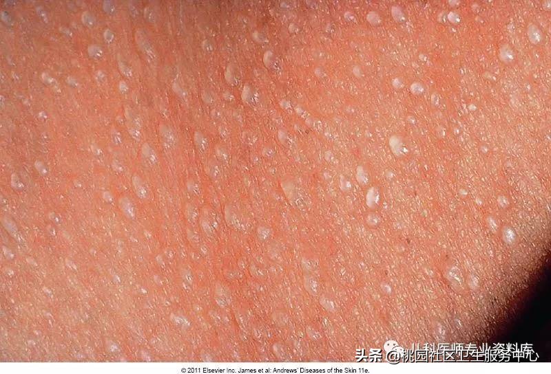 儿童湿疹和痱子要分清楚,成人痱子和湿疹如何分别