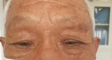 眼整形常见手术方式,眼整形美容手术