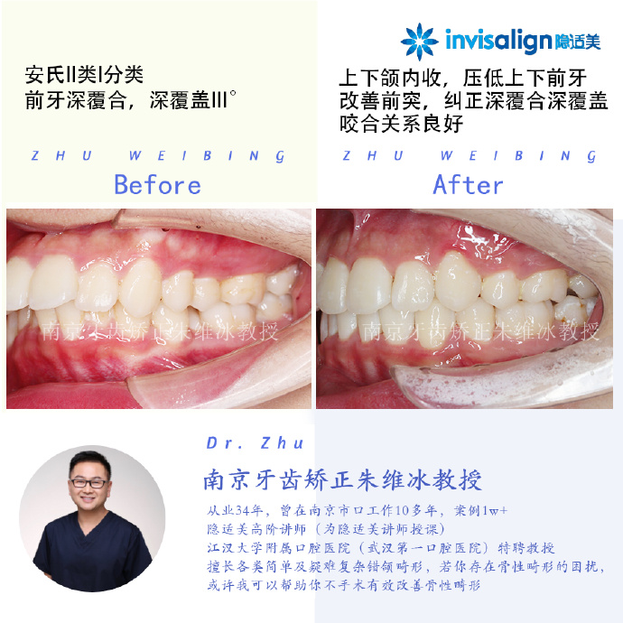 口腔正畸隐适美隐形矫治技术,隐适美深覆合矫正