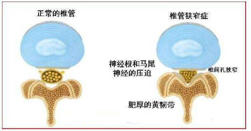什么是椎管狭窄,脊椎管狭窄的危害