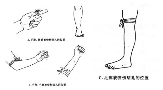被毒蛇咬伤，一个正确的处理能挽救一条生命！您知道吗？如何防治