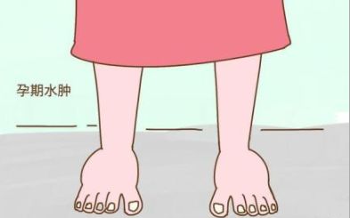 产后水肿快速消除方法,水肿3个月了怎么办