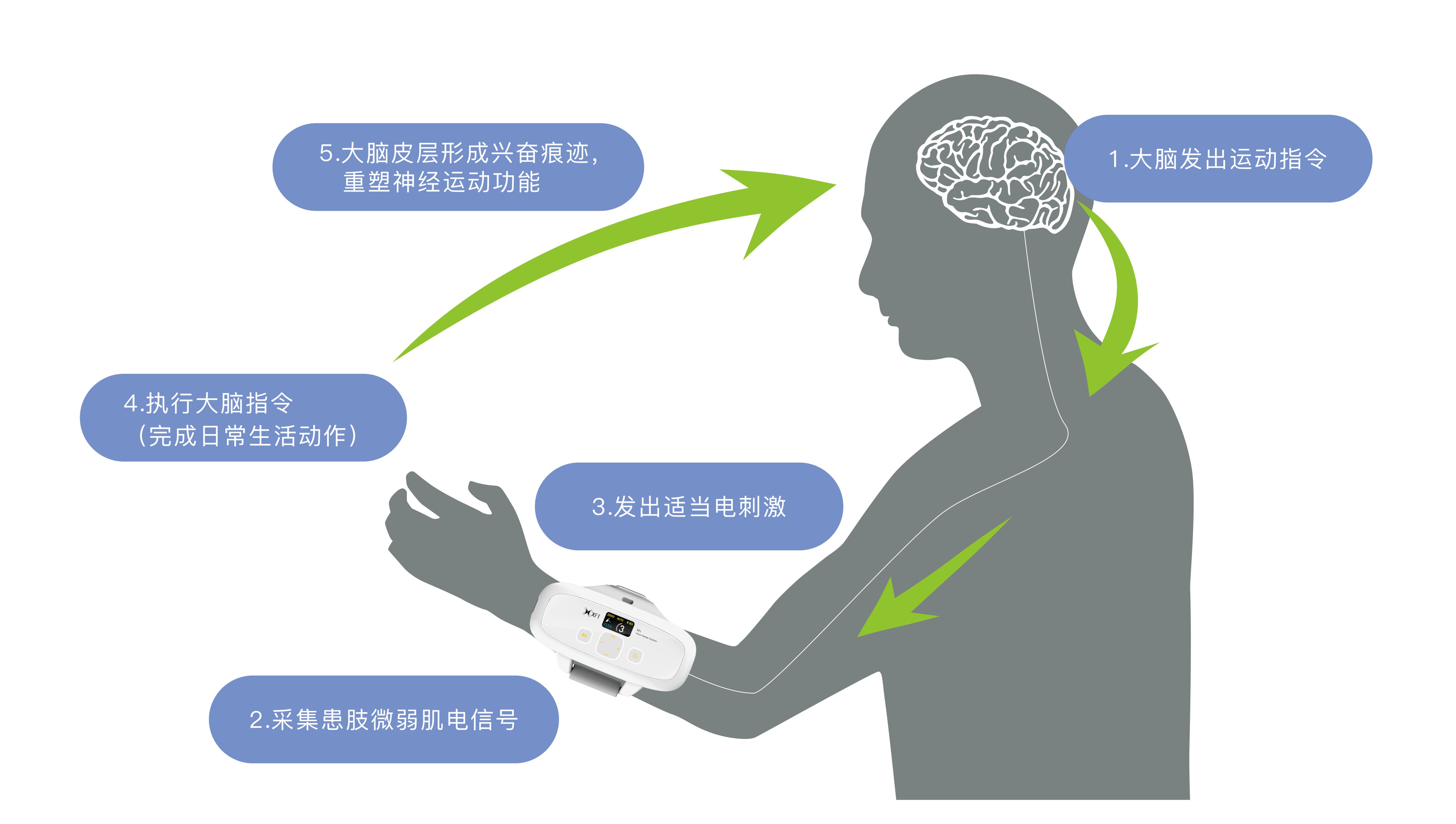 FES在脑卒中康复治疗中的应用分析