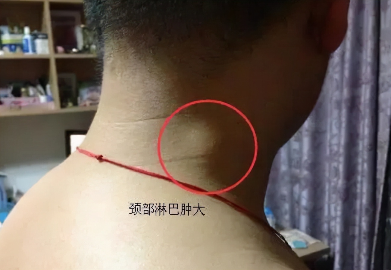 艾滋病窗口期会出现皮肤几种症状,艾滋病前期一定会出现皮肤问题吗