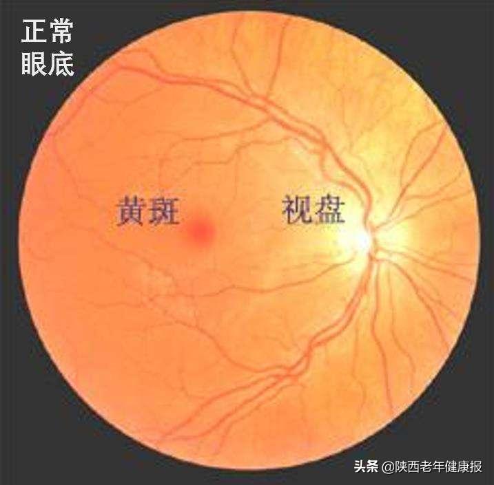 眼睛看不到东西医生说是黄斑病变,最近眼睛里长了黄斑