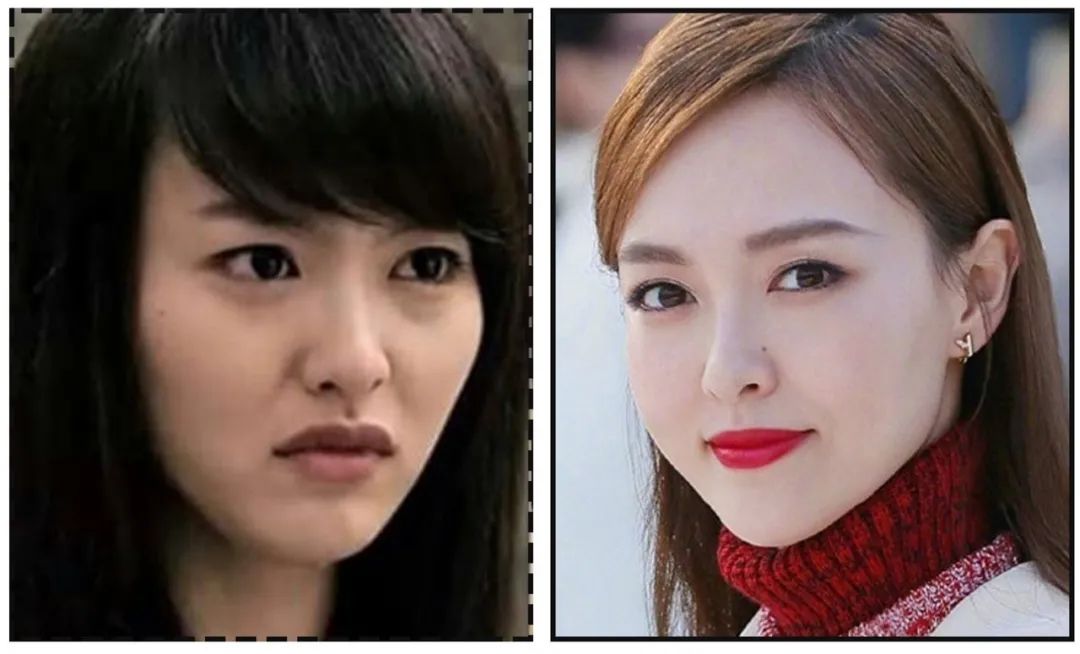 娄艺潇填充脂肪前后对比,娄艺潇填充前后对比