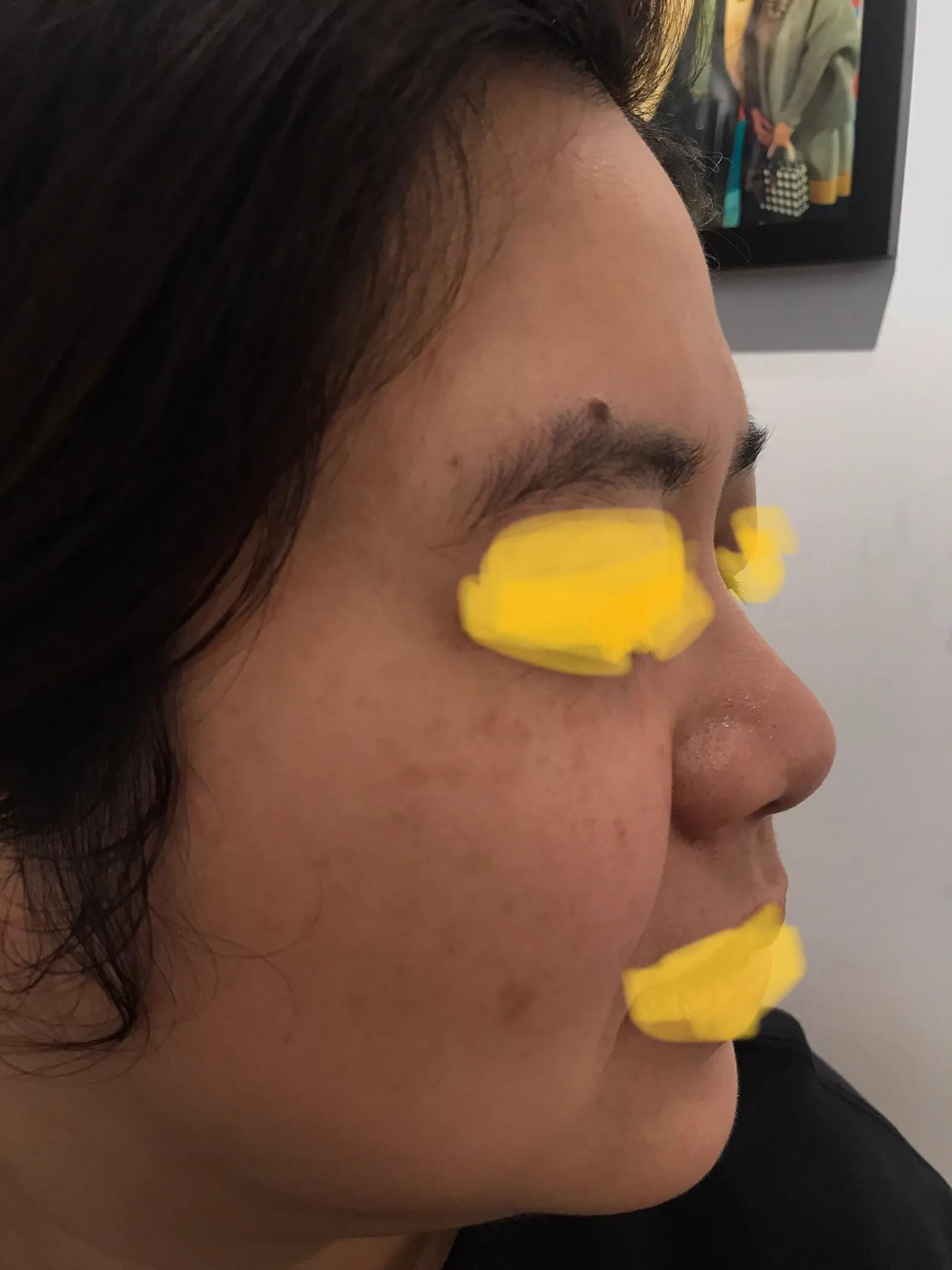 激光祛除斑点后留下的黑印,两次祛斑中间最好隔多久