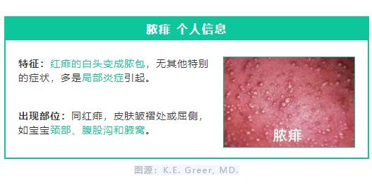 藿香正气水祛痱子快速消除,去痱子用风油精还是藿香正气液