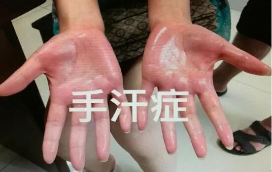 手汗多是不是大病的前兆,手汗流不止是什么原因
