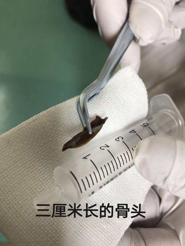 女孩长期咳嗽气管进入异物,女大学生反复咳嗽14年