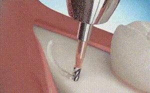 智齿疼是拔掉好还是治疗好,智齿疼是拔掉还是治疗