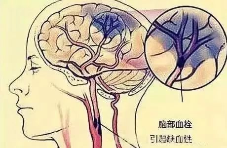 刮青筋防脑血栓,刮中指青筋防脑血栓