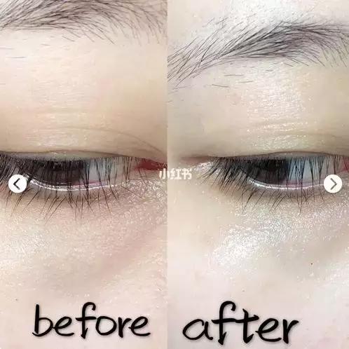 改善眼袋仅980元不开刀让你更出众,消除眼袋细纹大概多少钱