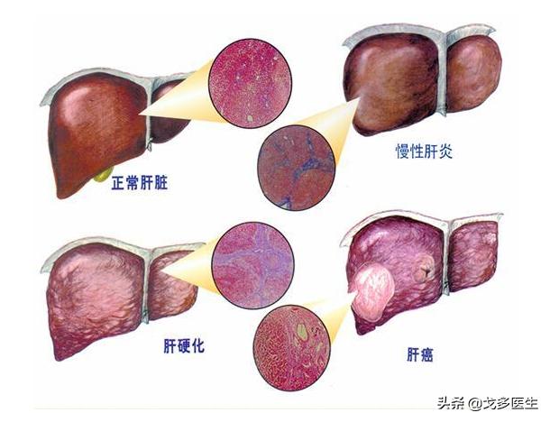 肚子疼真的那么简单吗？——慢性腹痛的一点点点的事