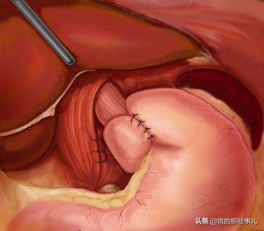 每次饭后胃胀怎么办,每次饭后胀气