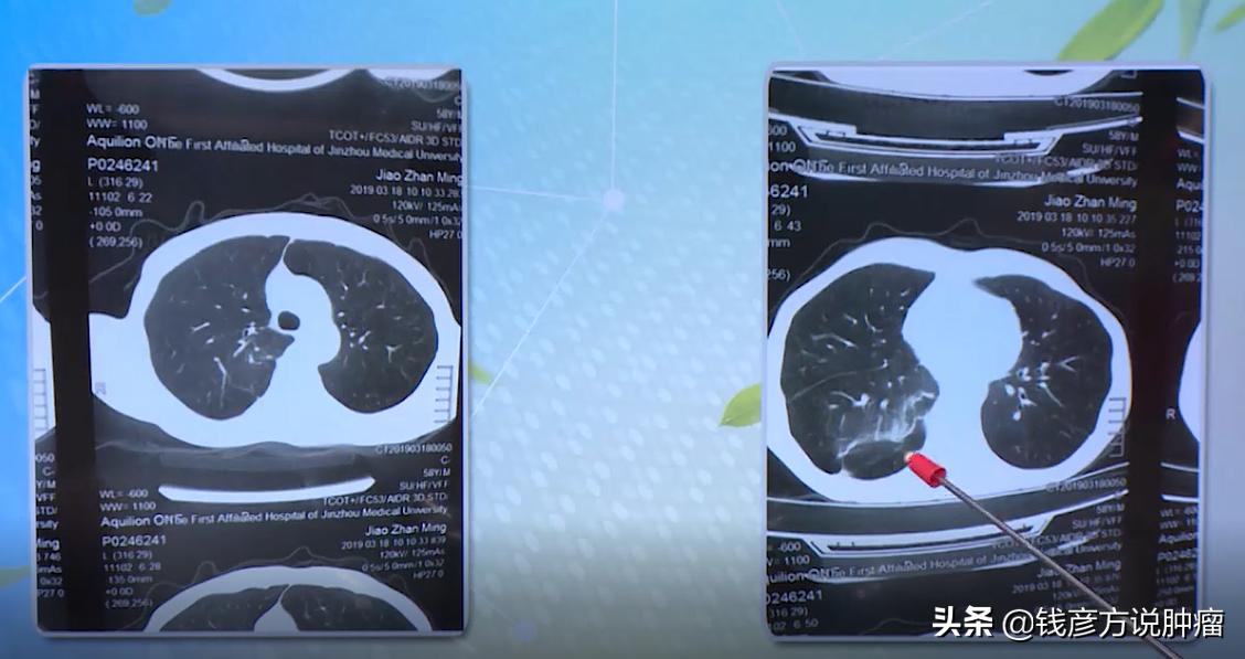 肺癌和肾癌靶向药物,肾癌术后转移肺癌早期还好治吗