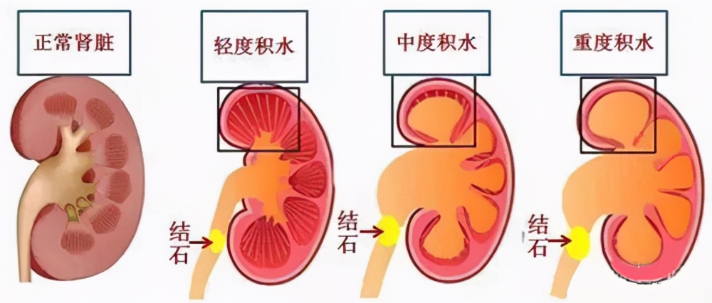 1厘米肾结石有事情吗,肾结石一个1.2一个1.6可以碎石吗
