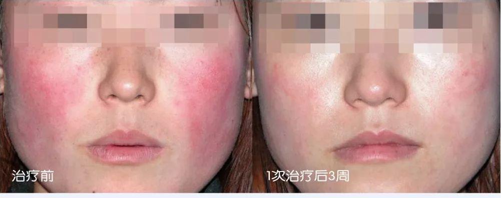 光子嫩肤的基本方法,光子嫩肤如何达到嫩肤效果