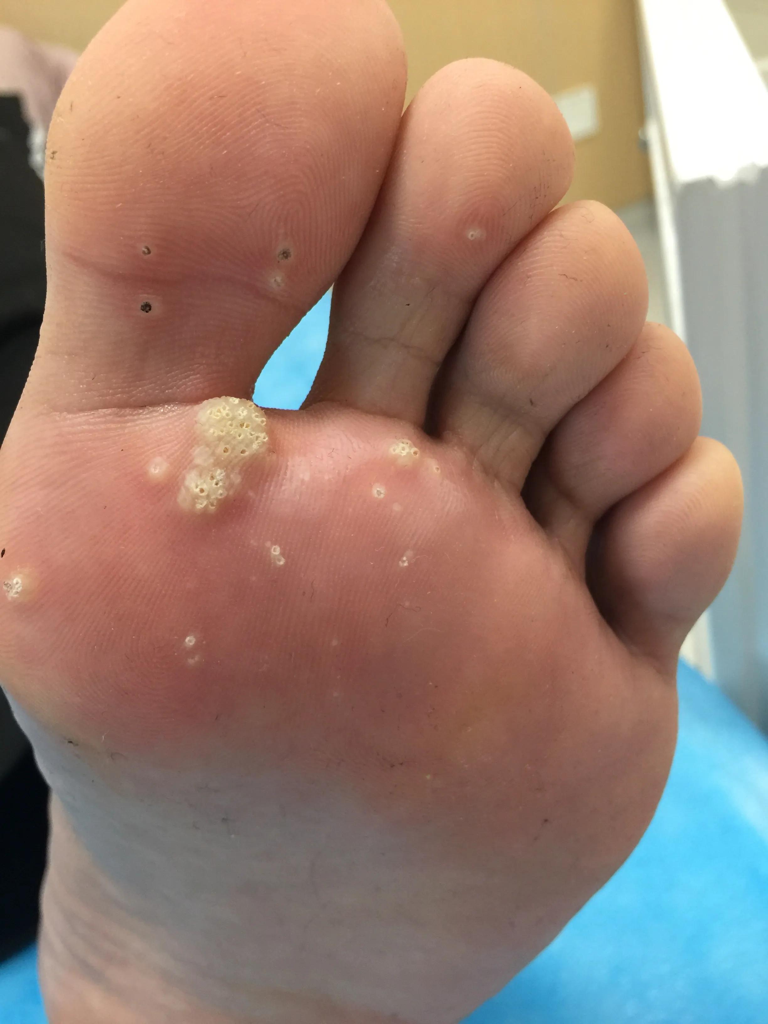 治疗跖疣火针和冷冻哪个疗效好,多发性跖疣的火针治疗