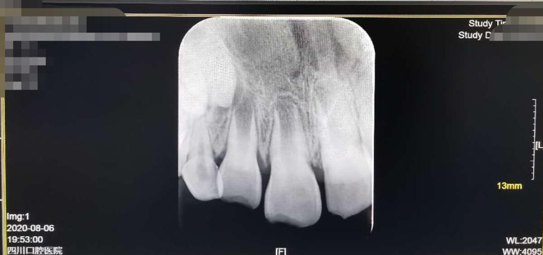 夏令营把牙齿摔了,夏令营孩子受伤谁的责任
