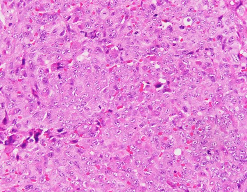 弥漫性肺泡出血是怎么回事,弥漫性肺泡出血症病因分类