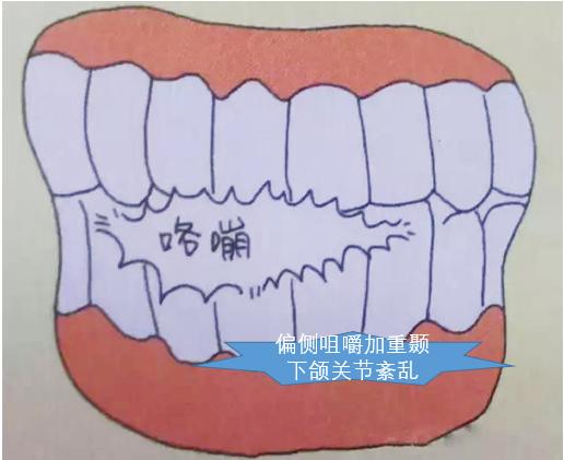 口腔咬合有咯噔响怎么治疗,口腔一张嘴就响怎么办