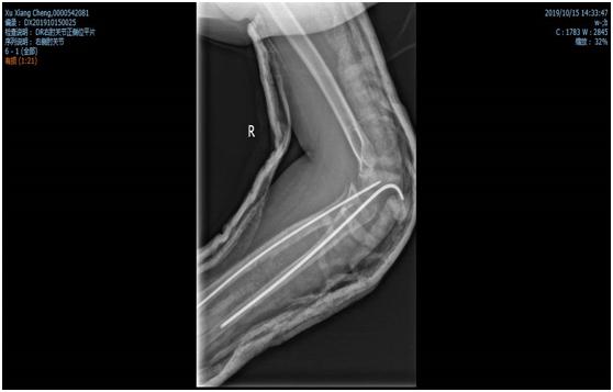 骨折一定要打石膏吗,骨折非要打钢钉吗