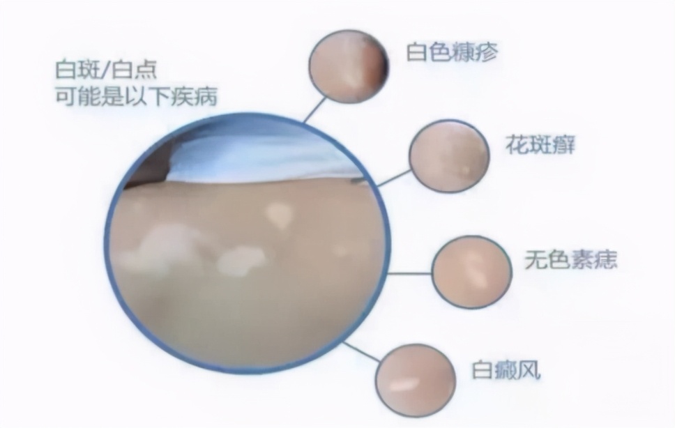 白斑是白癜风还是糠疹如何鉴别呢,宝宝脸上有白斑是脾胃虚吗