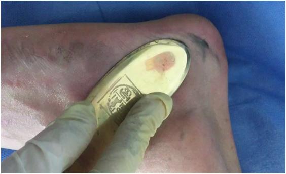 中医治疗痛风的有效方法,中医治疗痛风的思路是什么