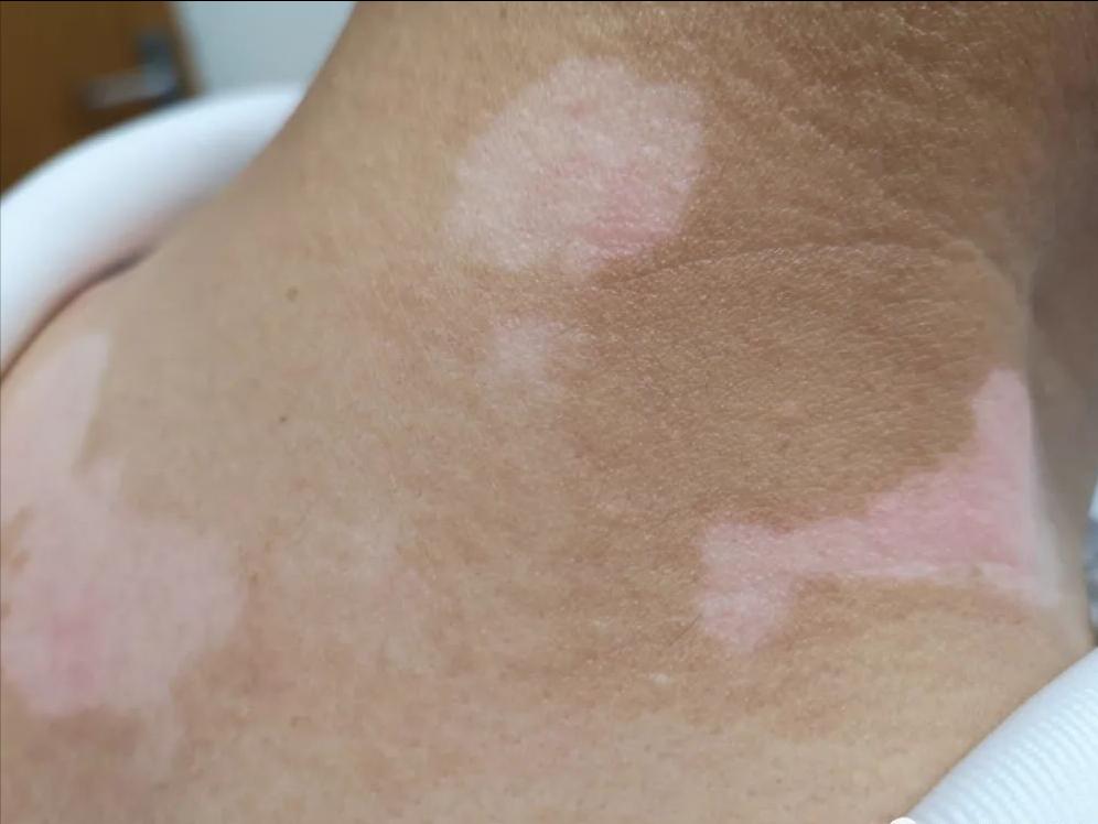 白癜风是个什么,白癜风到底是什么