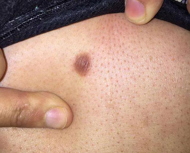 扁平疣和黑色素痣区别,疣与色素痣的区别