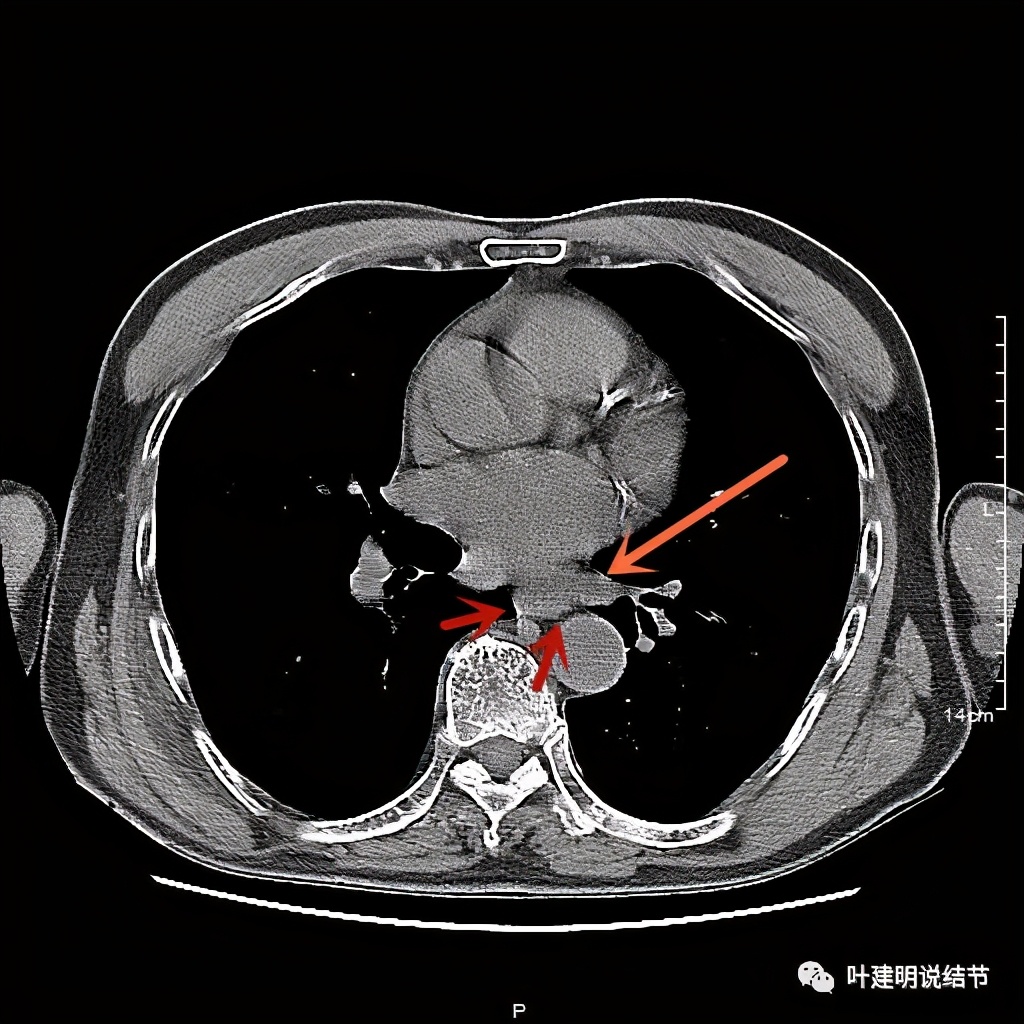 同时患结肠癌和直肠癌怎么办,同时查出了胃癌和肺癌怎么办