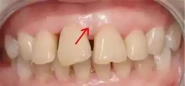 牙齿黑三角怎么补救,牙齿上的黑三角怎么改善