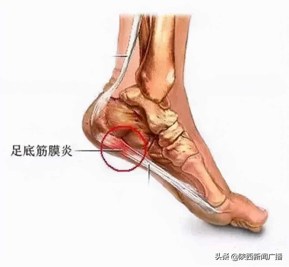 脚后跟疼是怎么回事中医,脚后跟疼是怎么回事一走路就疼