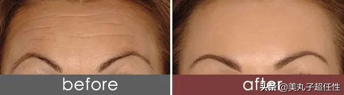 抬头纹最佳解决方法医美,教你一招解决抬头纹