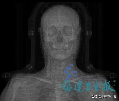 34岁女子宫颈癌自愈,女性患了宫颈癌能治愈吗