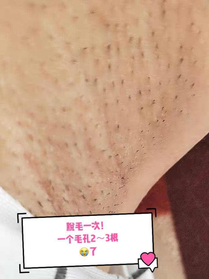 吐槽脱毛仪脱毛发炎,吐槽ellkii脱毛仪