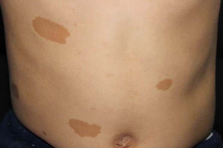 此“咖啡”非彼“咖妃”，今天来说说咖啡斑